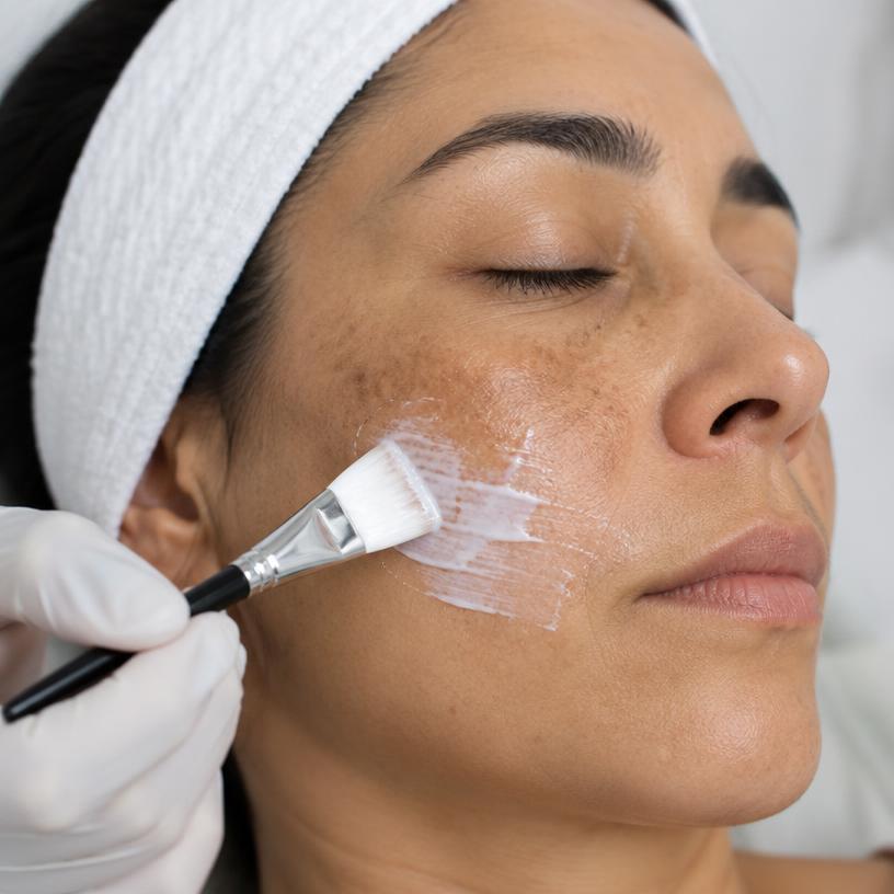 Foto 1 de Tratamento para Manchas e Melasma